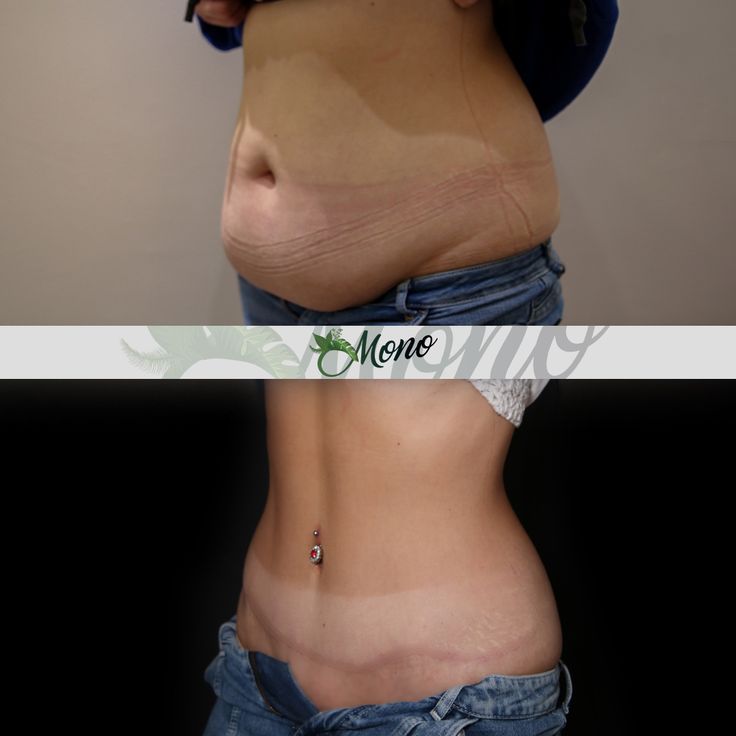 Pregnancy After a Tummy Tuck: What Happens to Your Results?